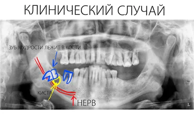 Как узнать что растет зуб мудрости / Мой BY — Информационный портал  Беларуси. Новости Беларуси