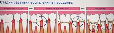 Шишка на десне, что делать? - Полезные статьи на сайте стоматологической  клиники Церекон