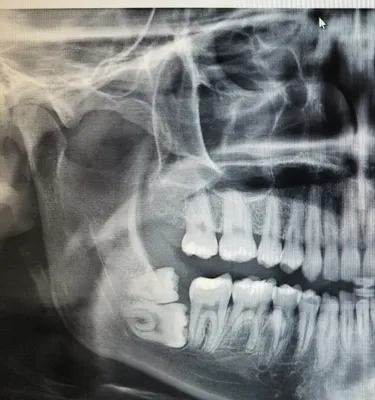 Удаление зуба мудрости в Хабаровск: цена сложного удаления восьмерки в  EsteticaDent.ru