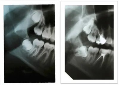 Ретинированный и дистопированный зуб - Удаление | SILK