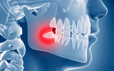 Флюс и абсцесс: причины, диагностика, методика лечения – стоматология  ПрезиДЕНТ