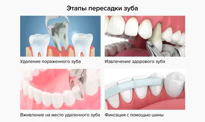 Удаление зуба мудрости в СПб: цена от 2 550 ₽ в клинике OrthoLove