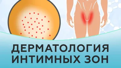 Половой псориаз у женщин и мужчин: лечение псориаза на половых органах