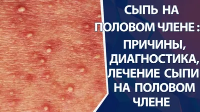 Прыщи на лобке и половых губах у женщин: диагностика и лечение - Газета.Ru