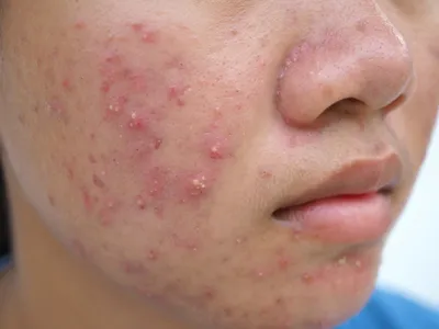 Генитальная аллергия: какие симптомы и как лечить?