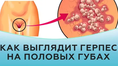 Папилломы на гениталиях - как вести половую жизнь с ВПЧ? | Лазерсвiт в  Харькове