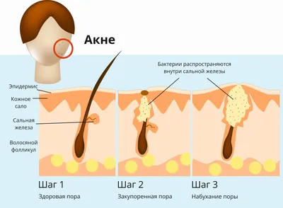 Баланит и баланопостит