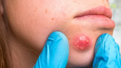 Герпесвирусная инфекция - причины, симптомы, диагностика, лечение и  профилактика