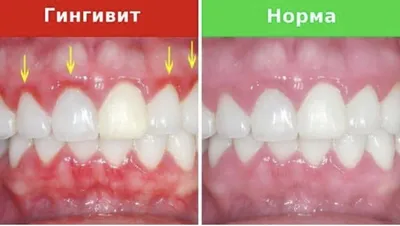Гингивит(воспаление десны) | Стоматология🦷🦷 | Дзен