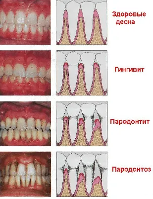 Диагностика и эффективное лечение десен зубов в Новосибирске