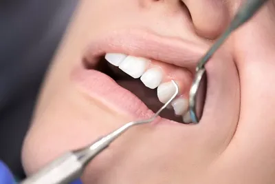 Лечение десен в СПб - в стоматологии ВашЪ ДантистЪ