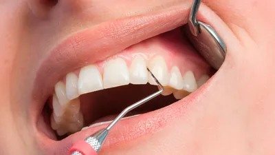 Воспаление десен и потеря зубов - стоматология Орбиталь