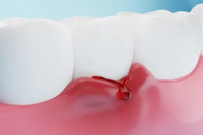 Лечение воспаленных десен - полезные статьи стоматологической сферы в блоге  «Гелиоса».