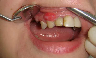 Лечение десен зубов в Астане: воспаление десен и пародонтоз - Stomak