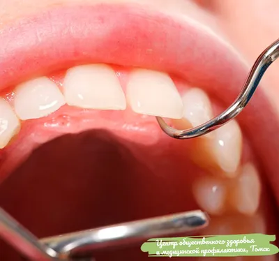 Лечение гингивита в стоматологии Doctor Smile в Курске