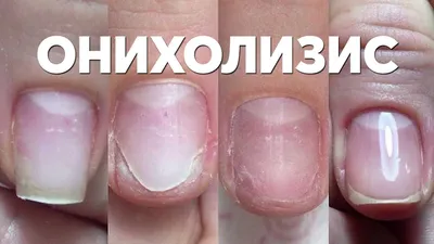 Заболевания ногтевой пластины» онлайн курс | Ксения Чумак - YouTube