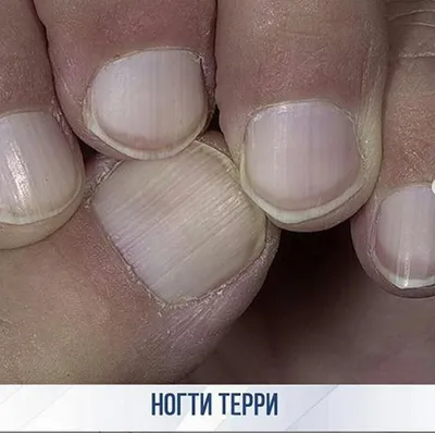 Почему скручиваются ногти – причины, способы лечения и профилактика проблемы