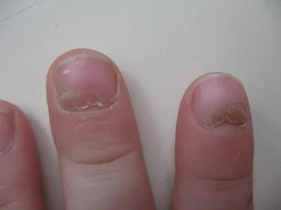 Онихолизис: причины, диагностика и лечение отслоения ногтя в Москве