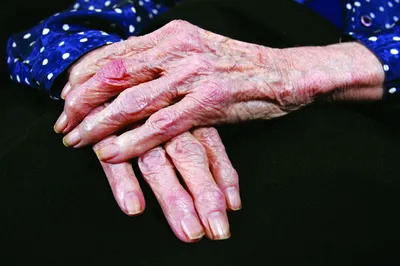 Грибковые заболевания кожи и ногтей - Заболевания кожи и ногтей. Уход за  кожей - Минский городской клинический центр дерматовенерологии