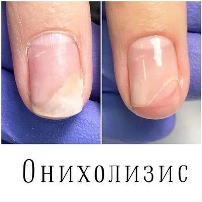 Лечение и профилактика утолщенных ногтей в Киеве