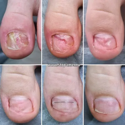 Синегнойная палочка на ногтях - симптомы и лечение