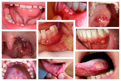 Болезни десен, слизистой оболочки полости рта и их лечение