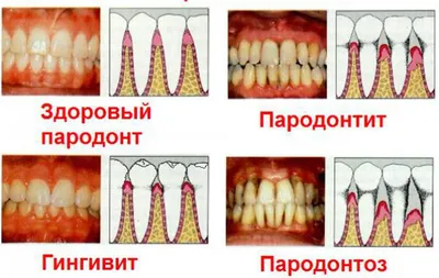 Заболевания Слизистой Оболочки Полости Рта У Детей.