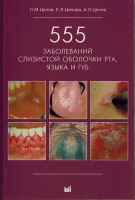 Лечение заболеваний слизистой оболочки полости рта в Благовещенске - Стомекс