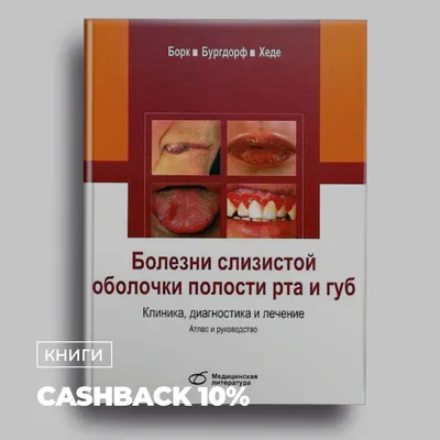 Изменение слизистой оболочки полости рта при сердечно-сосудистых  заболеваниях