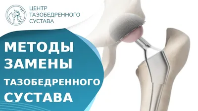 Тотальное эндопротезирование тазобедренного сустава - KinesioPro