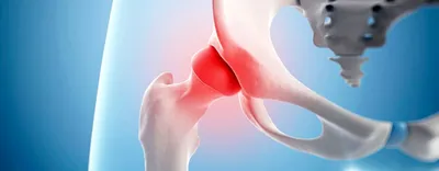 Эндопротезирование тазобедренного сустава ⋮ MEDICAL PLAZA