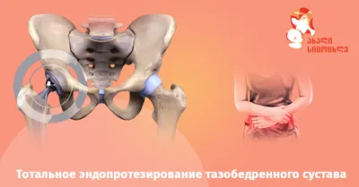Хирургия тазобедренного сустава с минимально инвазивной тотальной заменой  тазобедренного сустава