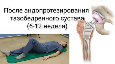 Ревизионное эндопротезирование тазобедренного сустава