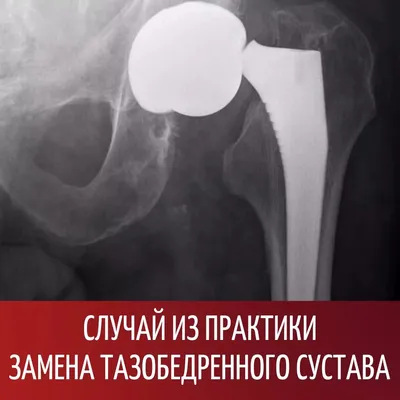 ▷ Эндопротезирование тазобедренного сустава • Цена • Операция по замене  тазобедренного сустава в Одессе, Херсоне, Николаеве | Врача Алексеева Н. И.
