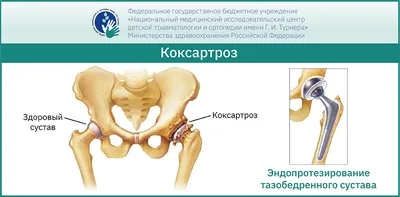 Эндопротезирование тазобедренного сустава в Москве