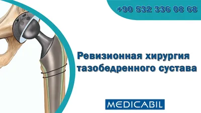 Клиника доктора Светашова - Эндопротезирование тазобедренного сустава