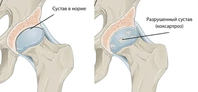 Замена тазобедренного сустава в Турции, Стамбул | Цена ▷ ТОП-10+ клиник 2024