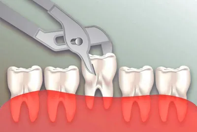 Удаление зуба при флюсе - цена от 3000 ₽ в Санкт-Петербурге | клиника  Медикор