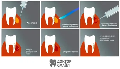 Флюс зуба | Флюс на десне: как лечить, чем полоскать, пить ли антибиотики