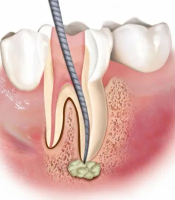 Что такое флюс зуба? Лечение периостита не терпит отлагательств