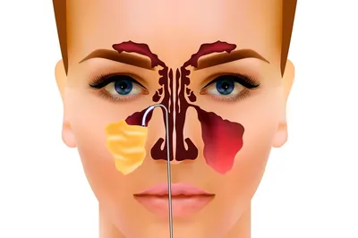 Прокол при гайморите - операция пункции пазух носа для лечения гайморита