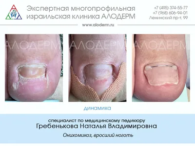 Лечение застарелого грибка ногтей | Клиника АЛОДЕРМ , Москва