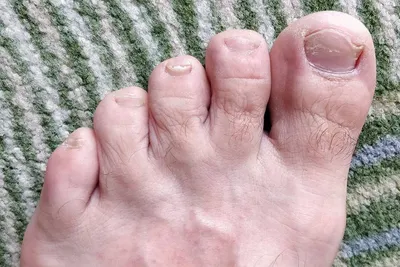 Грибок ногтей на ногах: что это, причины, сколько стоит лечение, лекарства  от онихомикоза