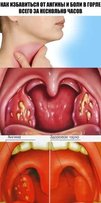 [32+] Здоровое горло фото