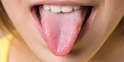 Налет на языке. Причины
