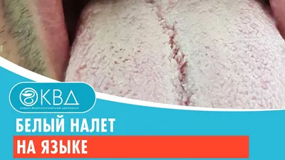 ᐈ Белый Налёт на Языке ➤ Причины образования, симптомы, лечение у взрослых  и детей