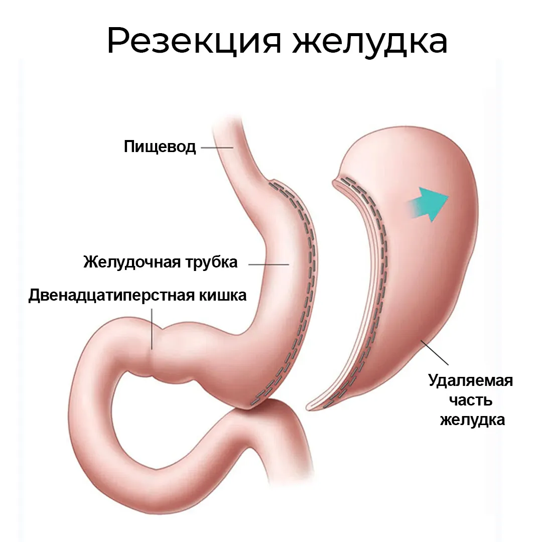 Резекция Желудка Для Похудения Цена В Новосибирске