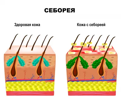 Механическа чистка лица. Пограмма 'Супервельвет' (жирная себорея) | Статьи