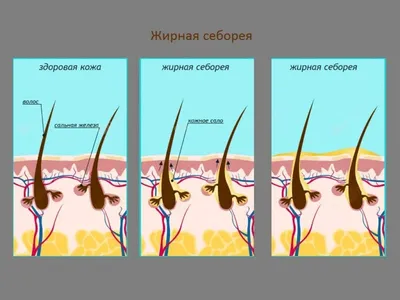 Себорея на голове у ребенка – причины и лечение, детский себорейный дерматит