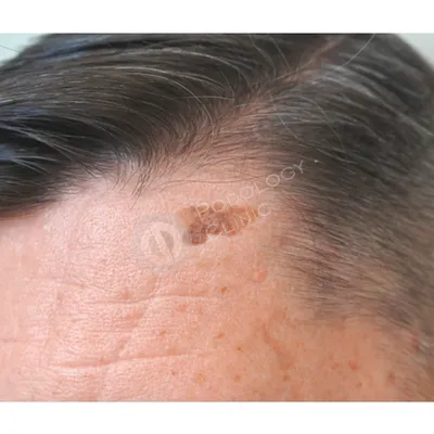 Удаление кератом в Москве | Лечение кератомы кожи на лице / теле, лечение  себорейных, старческих кератом в Клинике подологии Полёт